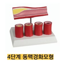 4단계 동맥경화모형 G240S/동맥 내 혈관이 좁아짐을 4단계로 표현