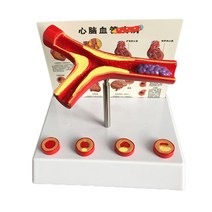 혈관 모형 동맥 경화증 지방 협착증 상담 자료 병리학, 갈라진 혈관