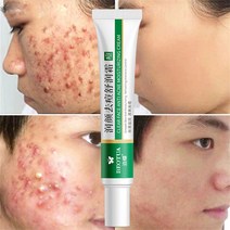 여드름크림 피부트러블 치료제 여드름흉터크림 청소년 성인용 스킨케어제