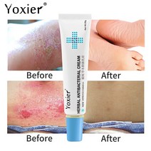 CAICHEN 릴리프 습진 피부염 두드러기 바디크림 허브 건선 항진균성 가려움증 크림, 4개 2개